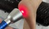 High-Intensity Laser Therapy – Discover Therapists Near You