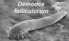 Demodex Mites: The Link to Chronic Dry Eye Issues