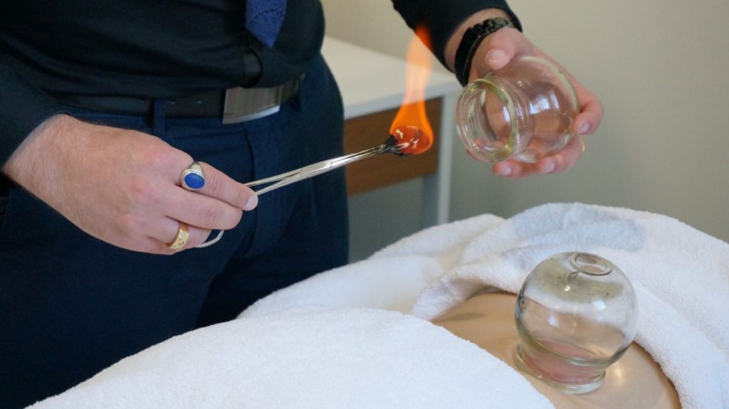 Cupping Therapy in Melbourne: Unveil Its Healing Advantages