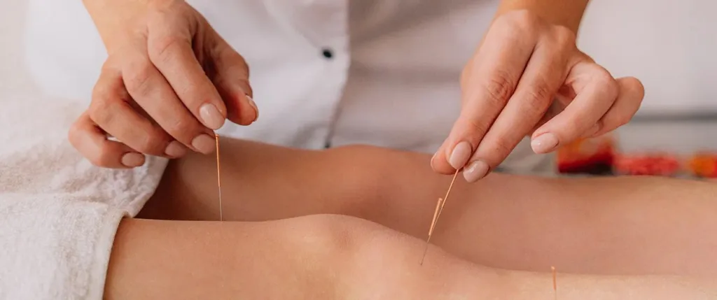 Acupuncture for Stress and Anxiety: A Key Guide