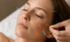 Cosmetic Acupuncture: Important Drawbacks to Know About