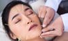 Cosmetic Acupuncture: Important Drawbacks to Consider